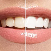 Teeth half before and half after whitening